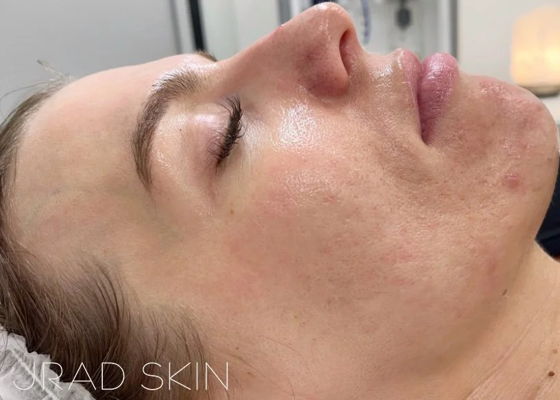After side-profile image of Amanda showing calmer-looking skin, fewer visible breakouts and softened acne marks along the cheek and jawline.