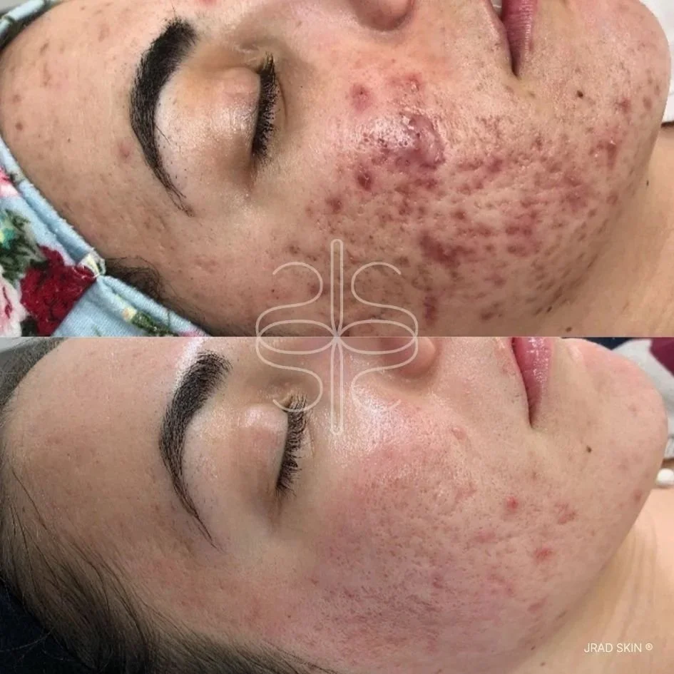Before and after acne treatment image showing reduced visible inflammation, breakouts and post-acne pigmentation on the cheek