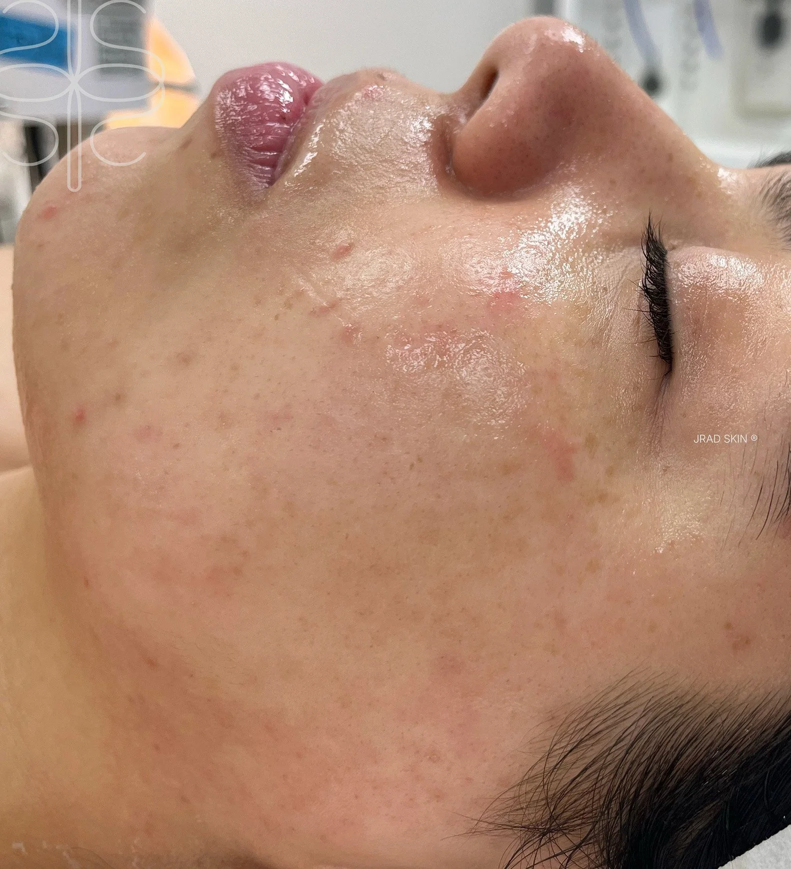 After side-profile close-up showing calmer-looking skin, reduced visible pigmentation and fewer pustules across the cheek and lower face.