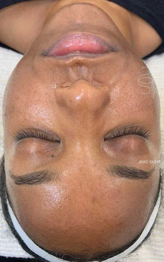 After front-facing image  of a Black woman showing brighter-looking skin, smoother visible texture and more even tone across the forehead and cheeks