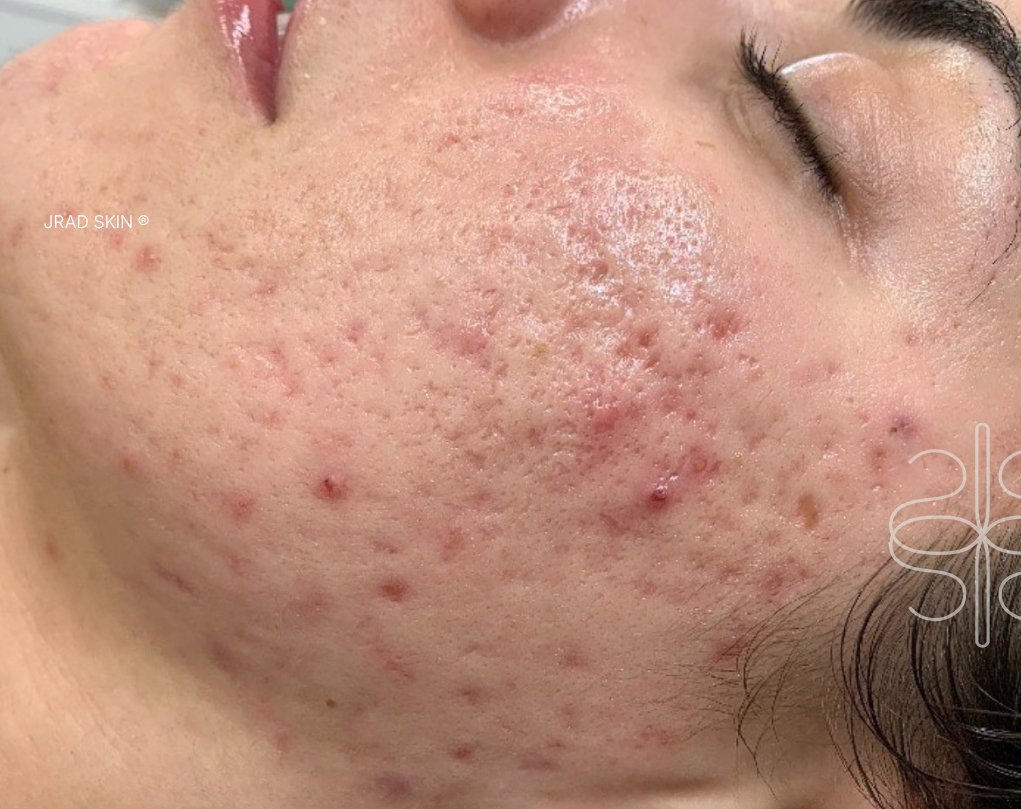 Close-up after image showing improved-looking skin clarity, reduced visible inflammation and softer post-acne pigmentation on the cheek