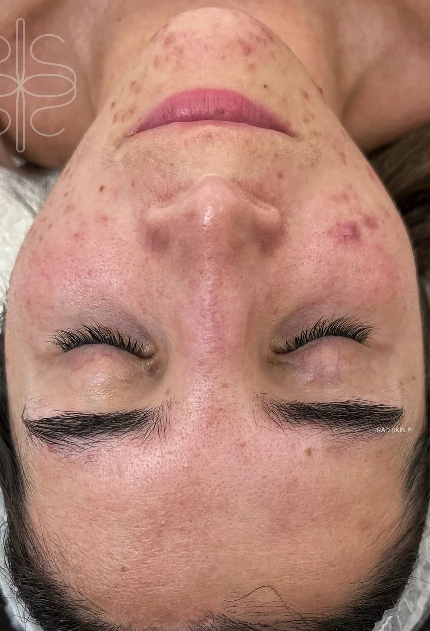 Before image showing visible congestion, pustules and post-inflammatory pigmentation prior to JRAD SKIN treatment plan