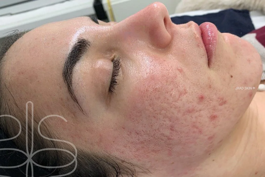 After image showing calmer-looking skin with reduced visible congestion and post-inflammatory pigmentation following JRAD SKIN treatment plan