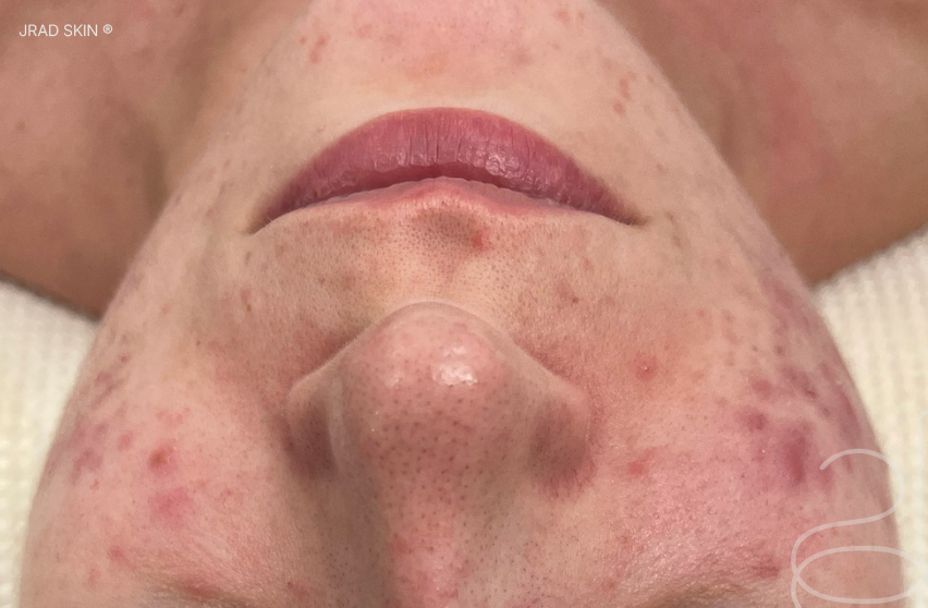 Before front-facing image showing congestion, small inflamed breakouts and post-inflammatory pigmentation across the cheeks, chin and around the mouth