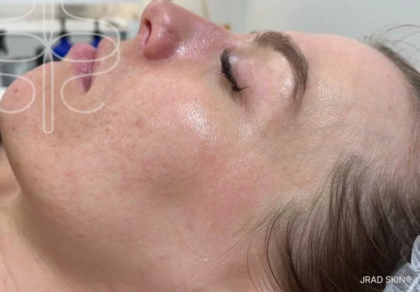 After side-profile image showing improved-looking clarity, smoother texture and reduced visible congestion across the cheek and jawline.