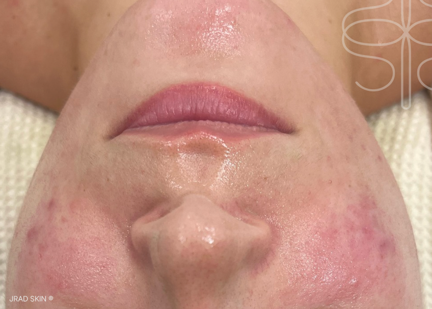After front-facing image showing reduced visible congestion, fewer inflamed blemishes and a more even-looking tone across the lower face