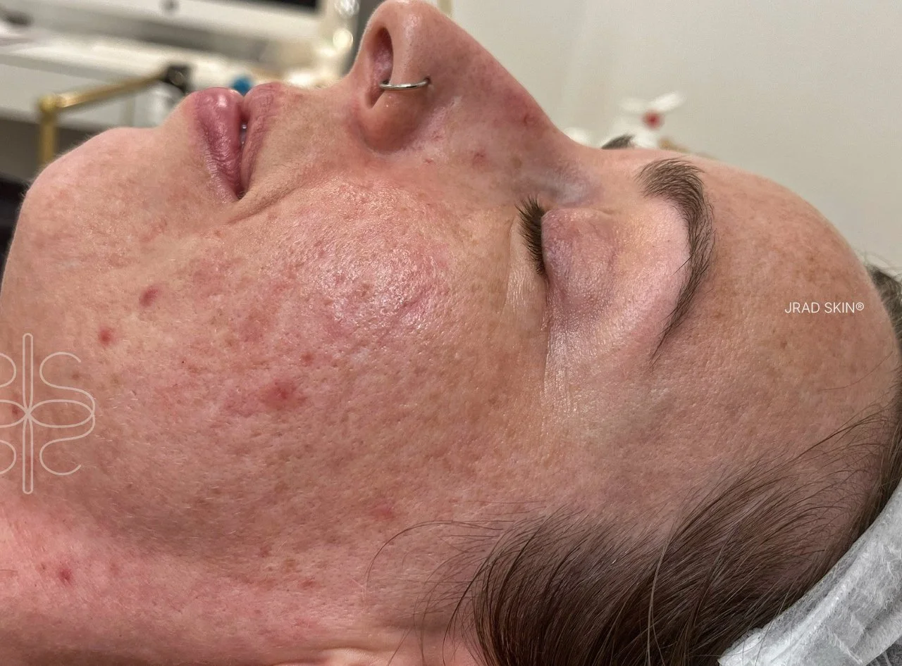 Before side-profile image showing hormonal breakouts, redness, pigmentation and textured acne scarring across the cheek and jawline.