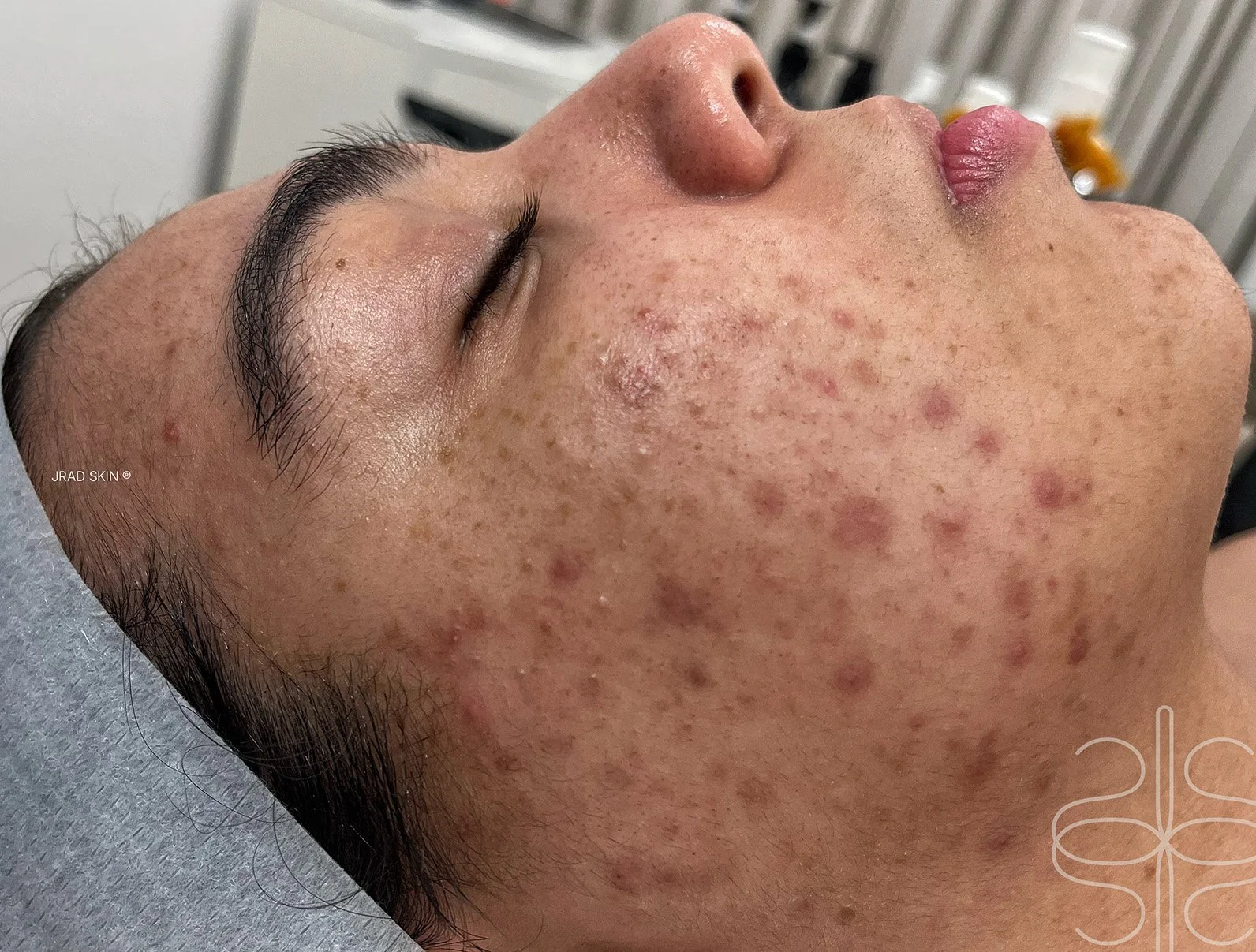 Before side-profile image showing post-inflammatory pigmentation, pustules and uneven texture across the cheek and chin area.