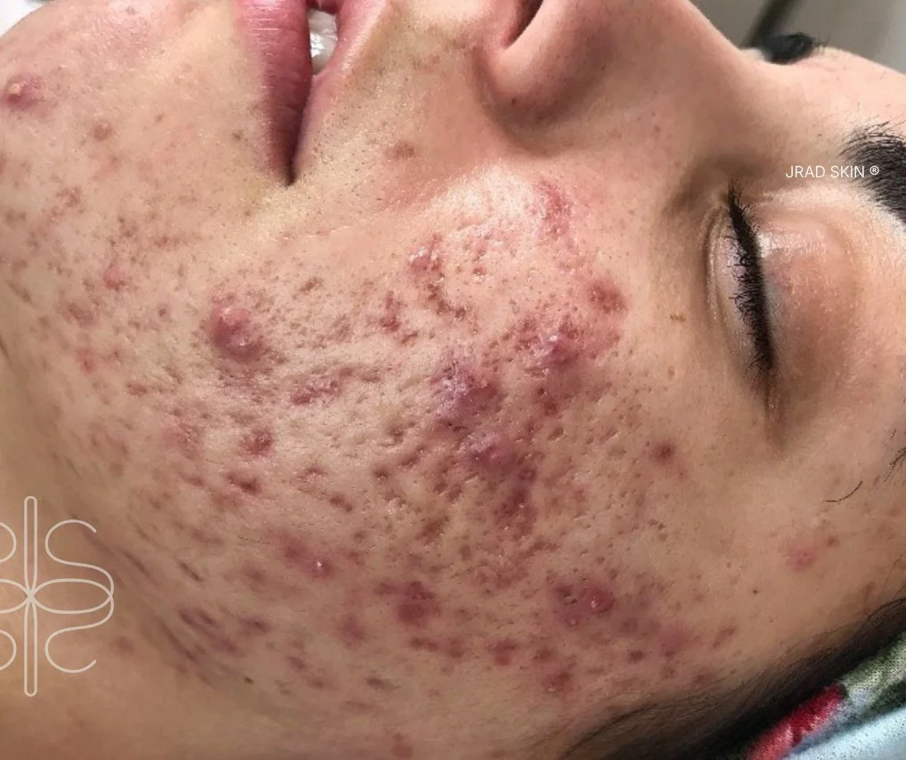 Close-up before image showing inflamed cystic breakouts, visible acne scarring and post-inflammatory pigmentation on the cheek