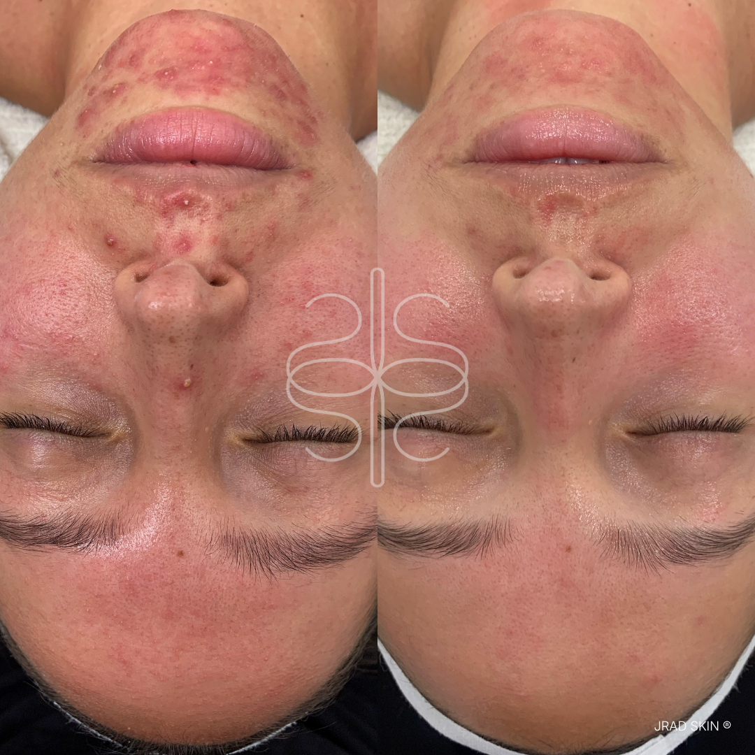 Before and after front-facing skin transformation showing fewer visible blemishes and a more even-looking skin tone around the chin and cheeks