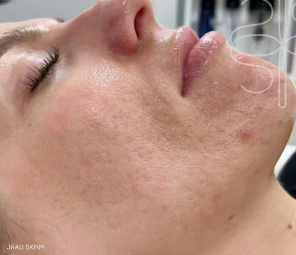 After cheek close-up showing calmer-looking skin, fewer active breakouts and softened visible acne marks on the lower cheek.