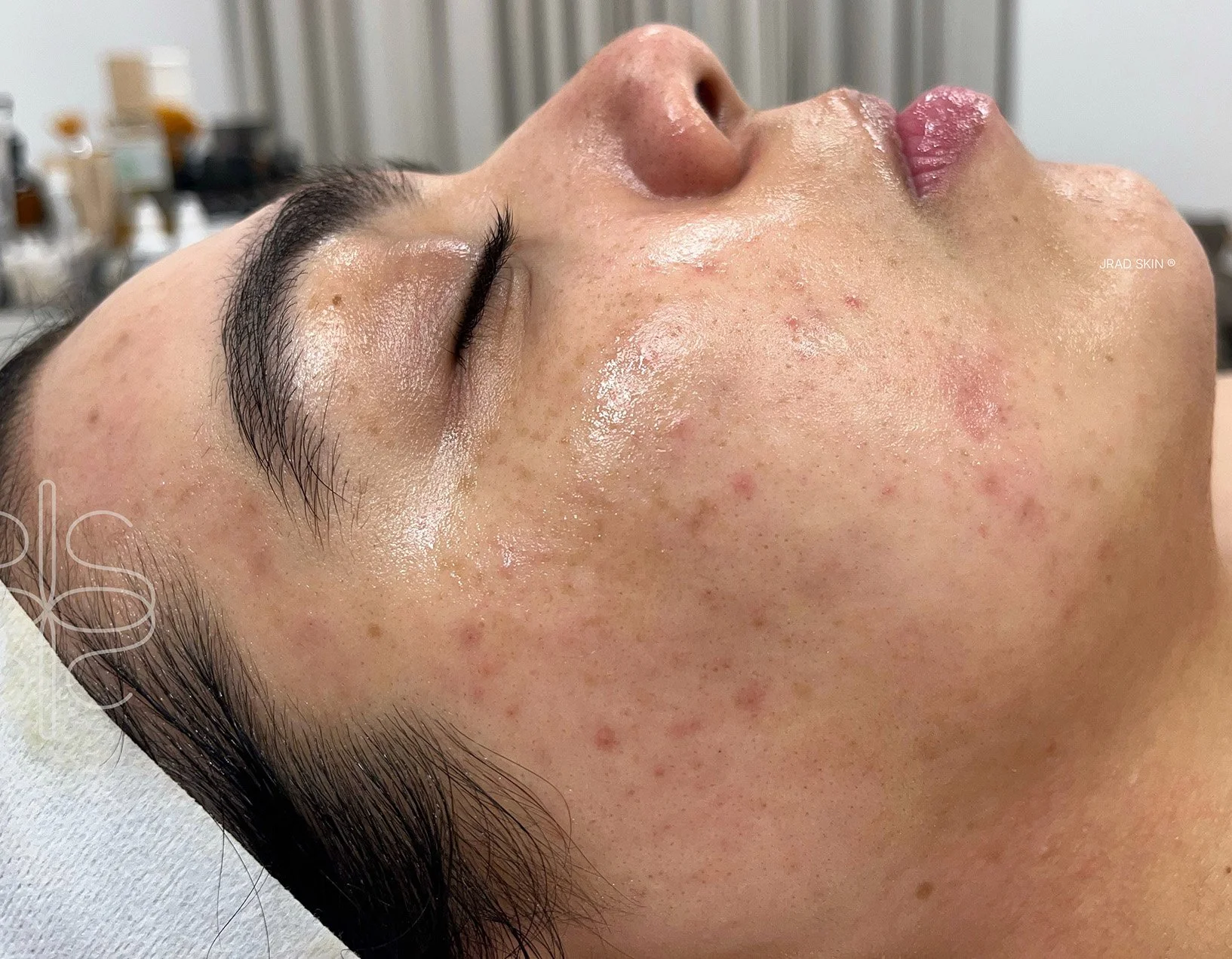 After side-profile image showing improved-looking clarity, softer pigmentation and fewer visible blemishes across the cheek and chin.
