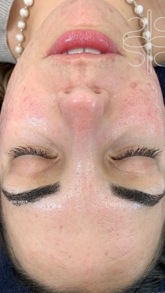 After treatment image showing reduced redness, fewer visible breakouts and a more even-looking skin tone across the cheeks and chin