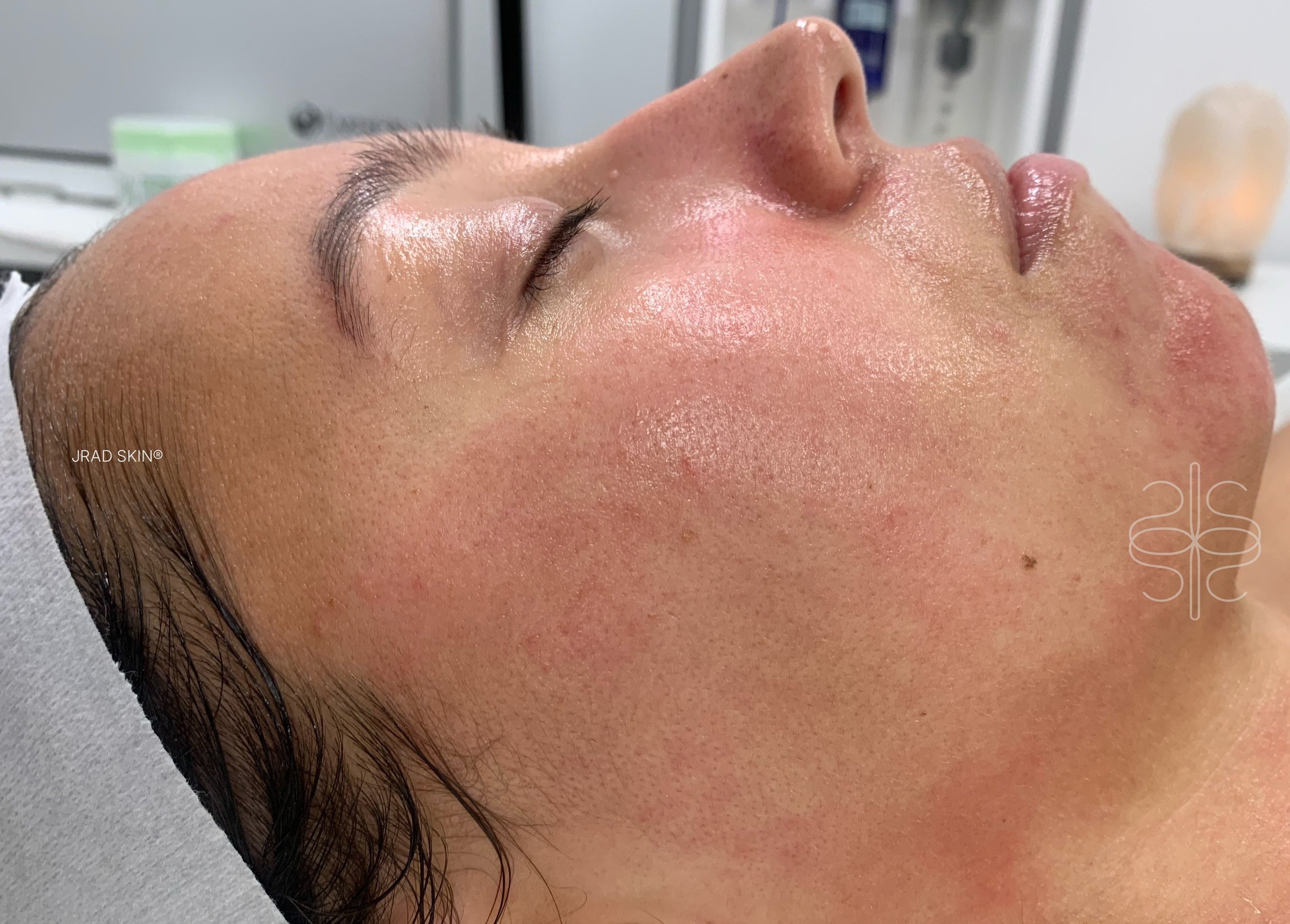 After side-profile image of Stacey showing calmer-looking skin, reduced visible redness and fewer blemishes across the cheek and chin.
