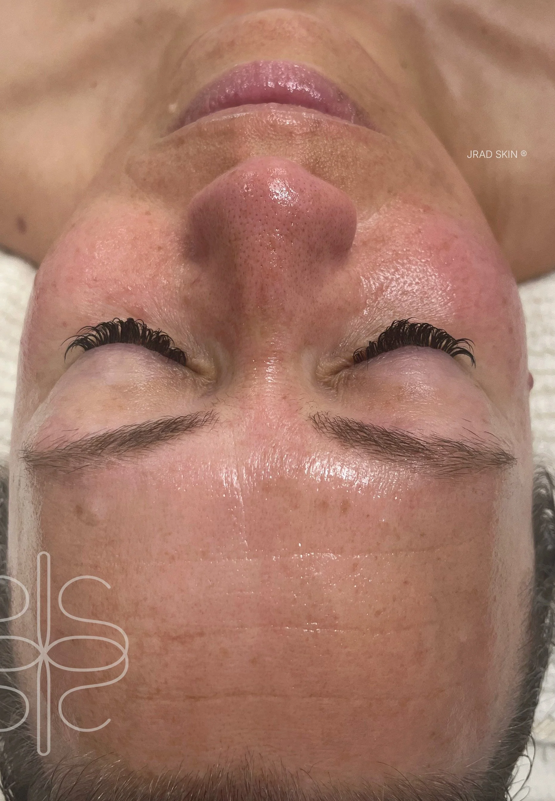 After front-facing image showing more even-looking tone, improved radiance and softened visible pigmentation across the face