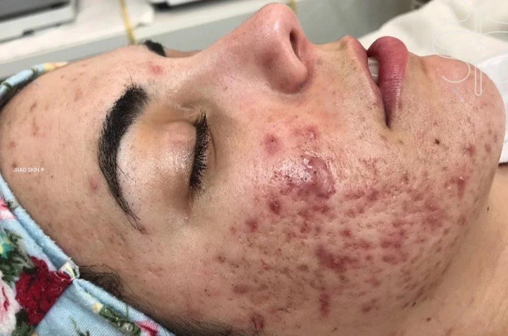 Before image showing severe hormonal acne, cystic breakouts, inflammation, atrophic acne scarring and post-inflammatory pigmentation prior to JRAD SKIN treatment