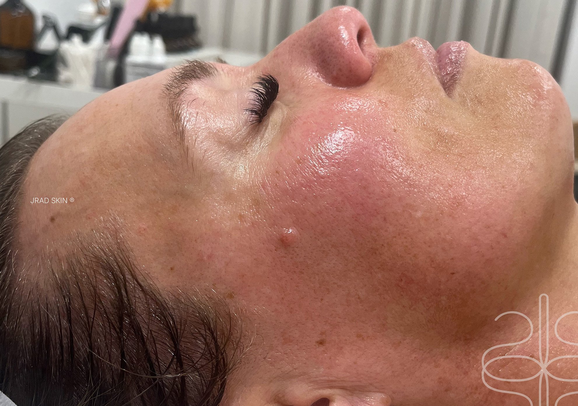 After side-profile image of Kaela showing brighter-looking skin with softened pigmentation and smoother visible texture