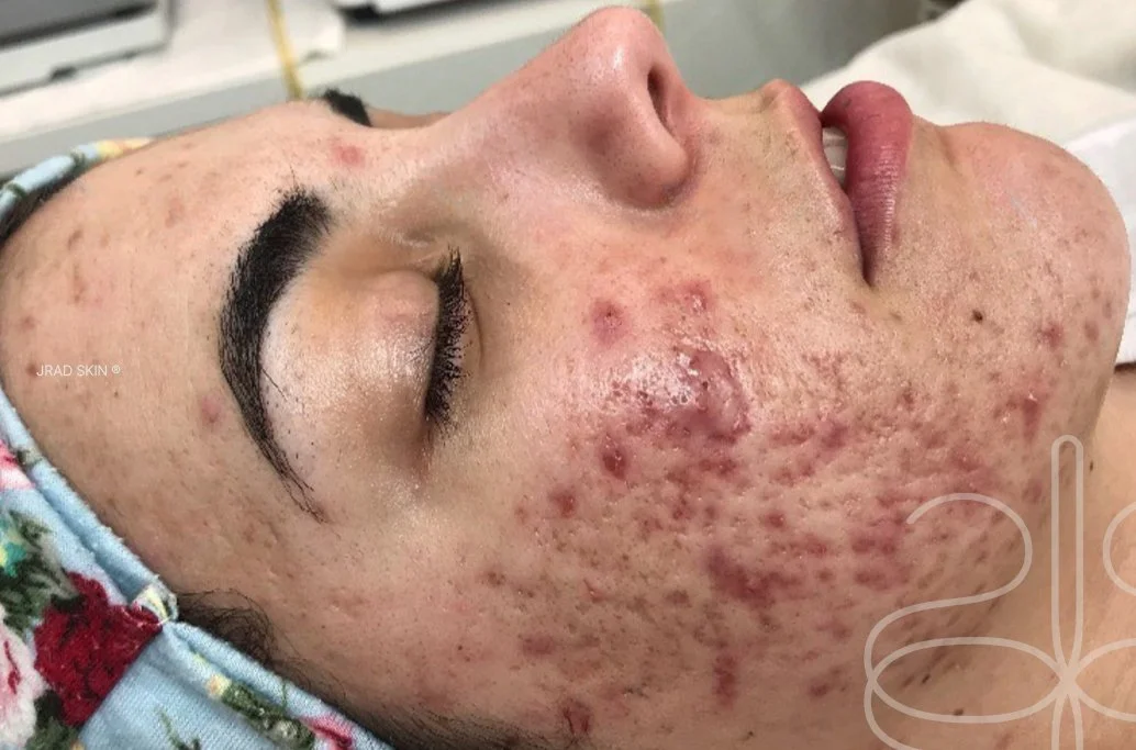 Before image showing acne, scarring, pustules and post-inflammatory pigmentation prior to JRAD SKIN treatment plan