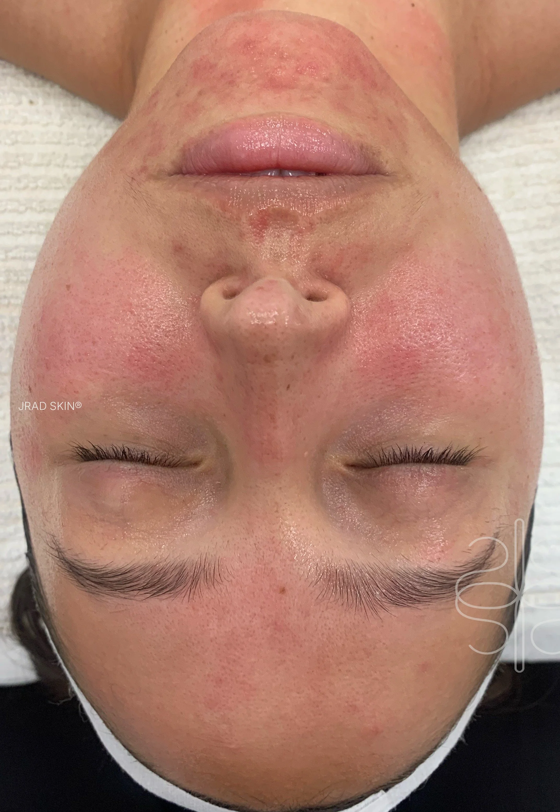 After front-facing image showing a calmer-looking complexion with reduced redness and fewer visible blemishes across the face.
