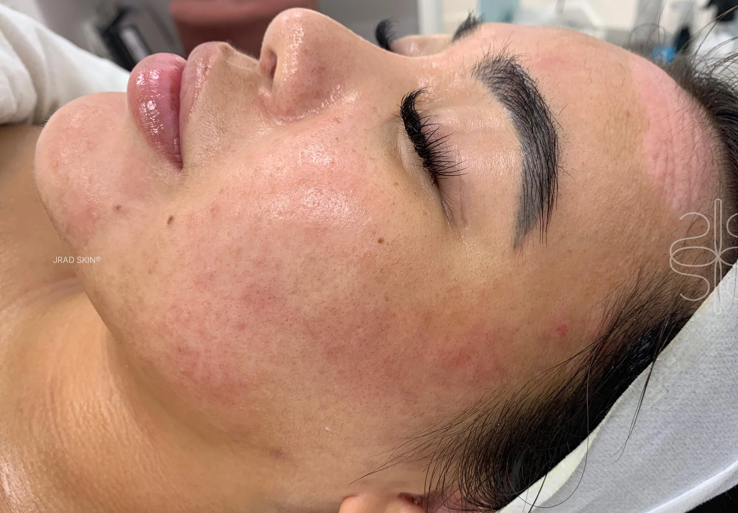 After side-profile image of Shaelynn showing calmer-looking skin, fewer visible blemishes and softened pigmentation across the cheek.