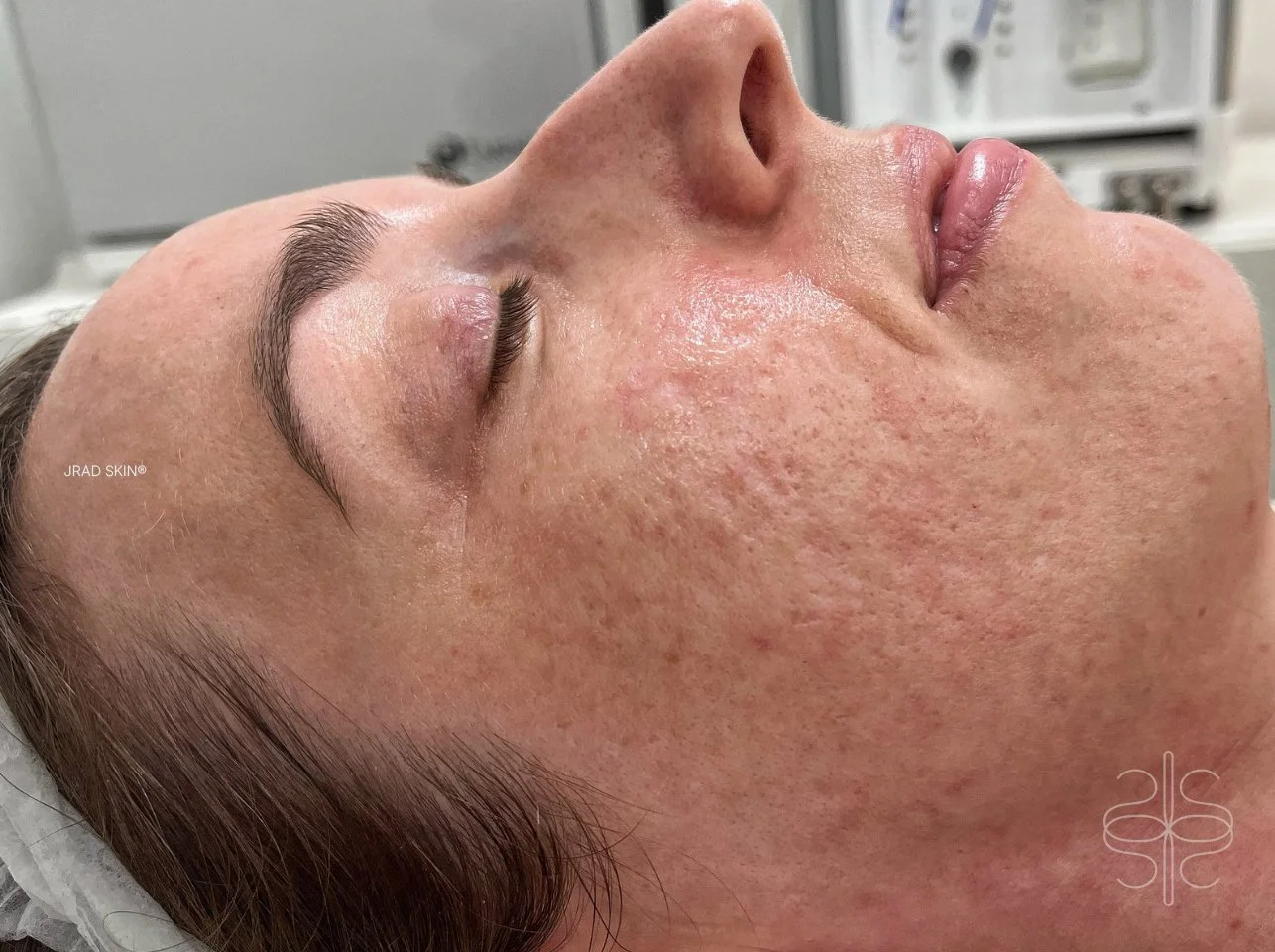 Before side-profile image showing atrophic acne scarring, pigmentation and uneven texture across the cheek before JRAD SKIN treatment.