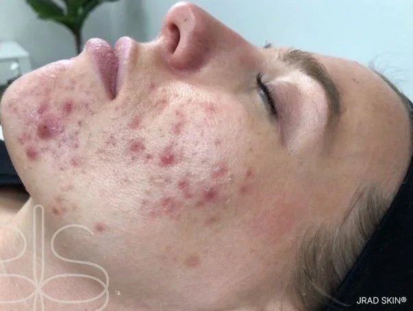 Before side-profile image showing cystic acne, congestion, visible scarring and redness across the cheek and jawline.