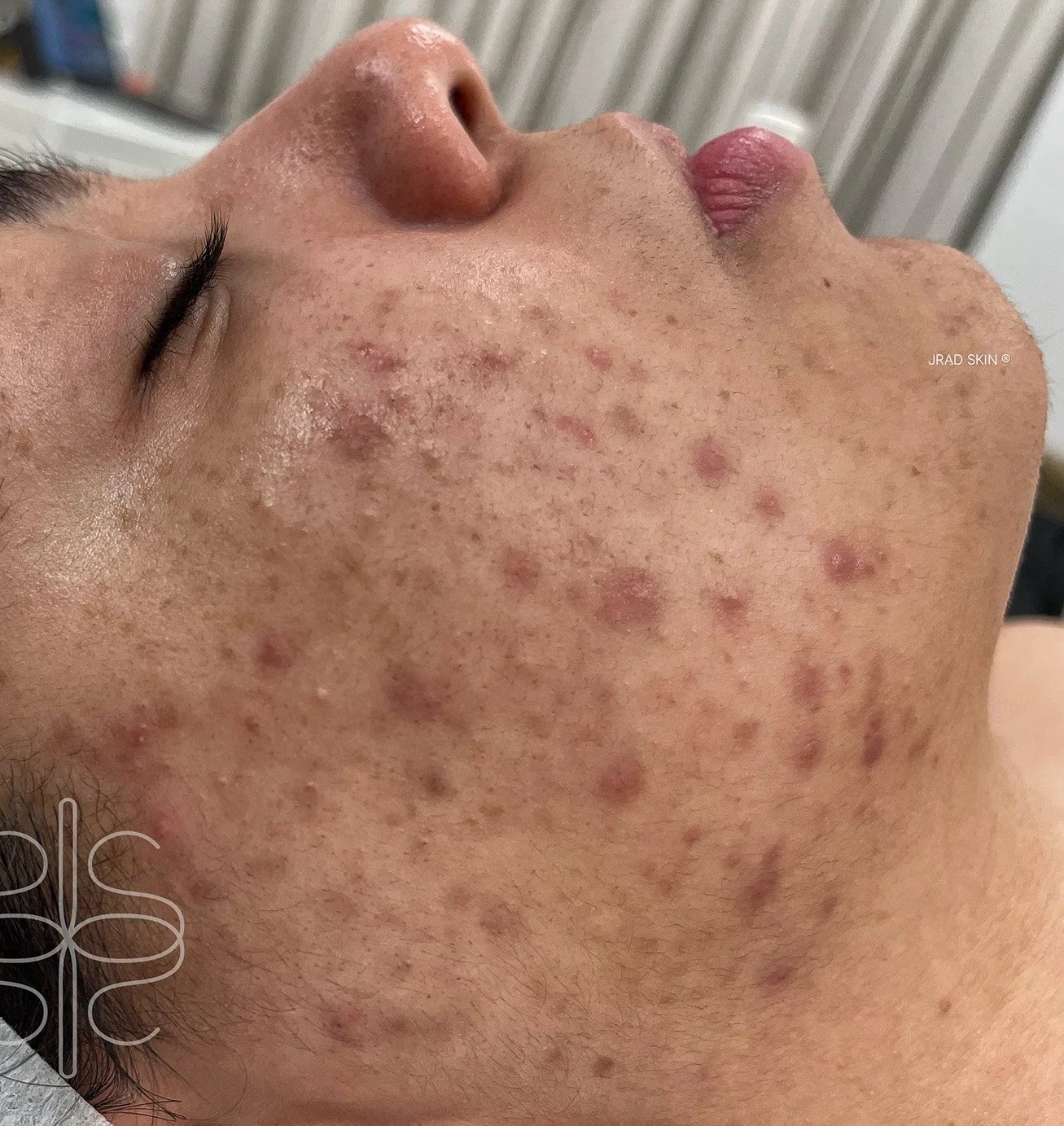 Before cheek close-up showing pigmentation, congestion, uneven texture and small inflamed blemishes across the lower cheek and jawline.