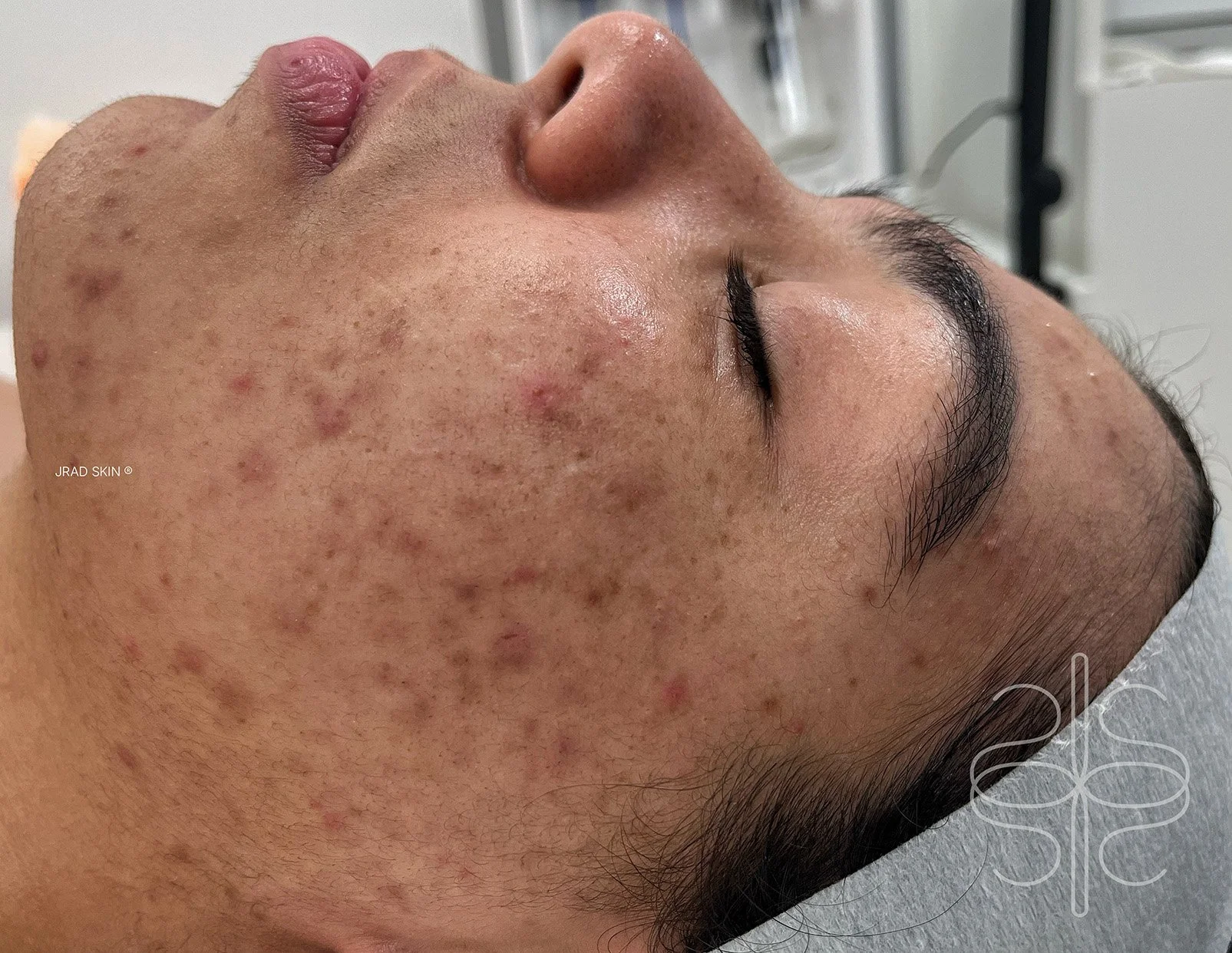 Before side-profile image of Ayah showing visible pigmentation, congestion and pustules along the cheek and jawline before JRAD SKIN treatment.