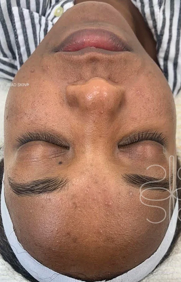 Before front-facing image of a Black woman showing uneven texture, visible pigmentation and congestion across the forehead, cheeks and chin