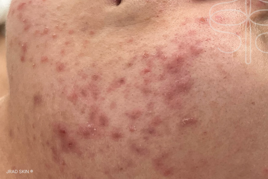 Before cheek close-up showing clusters of hormonal acne, redness, uneven texture and post-inflammatory pigmentation