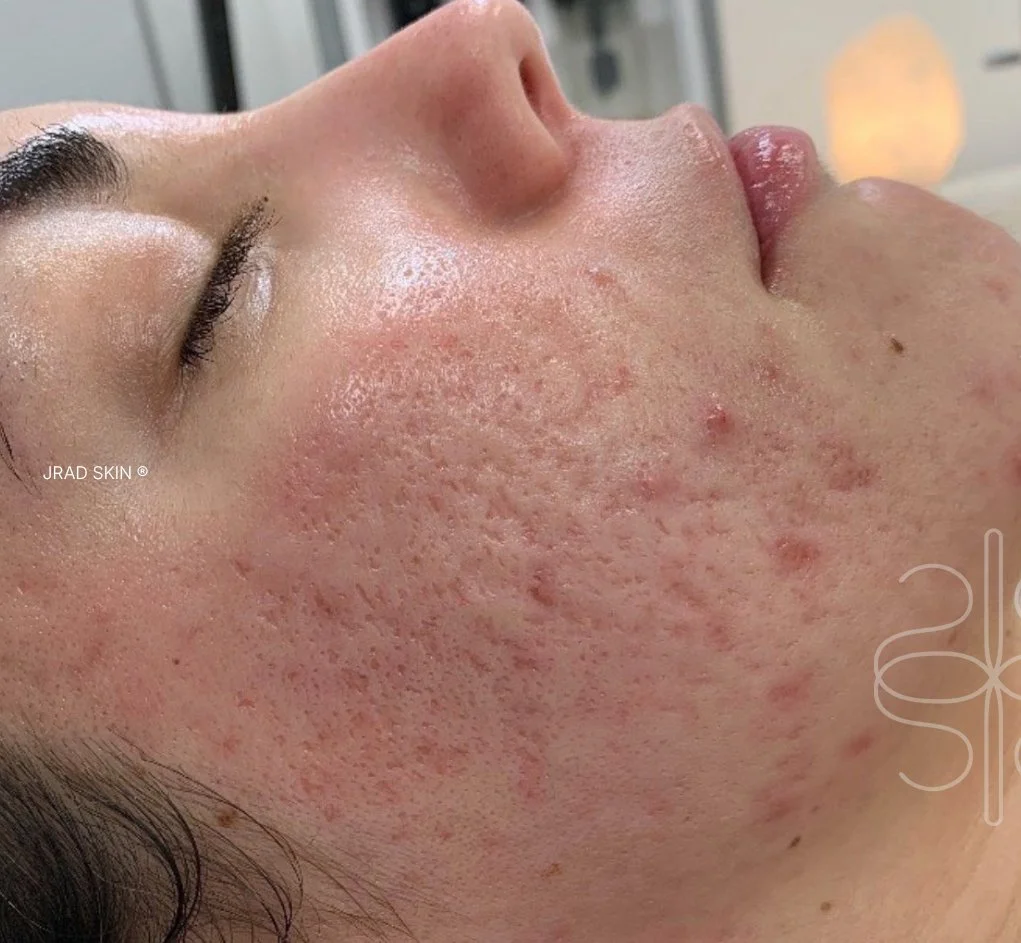After side-profile image showing calmer skin with fewer active breakouts and softer-looking post-acne marks along the cheek
