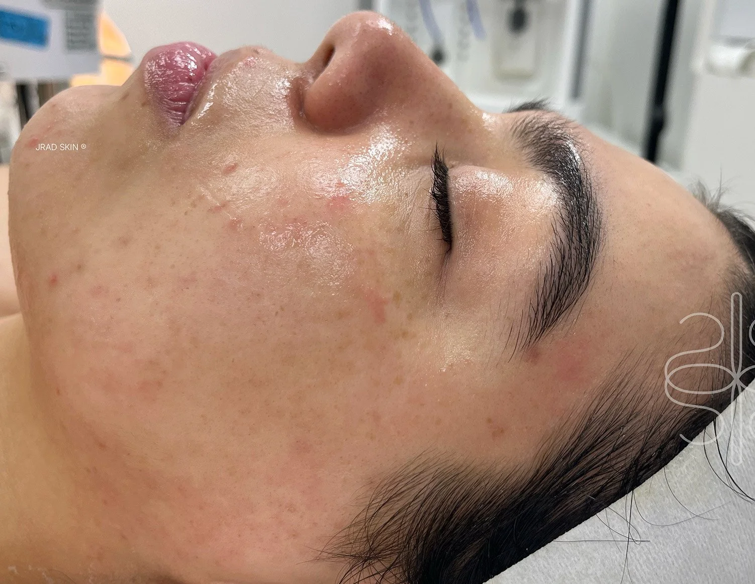 After side-profile image of Ayah showing calmer-looking skin, fewer visible pustules and softened pigmentation along the cheek and jawline.