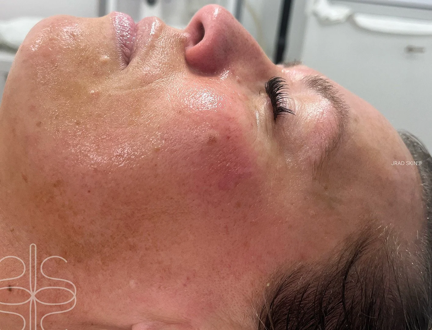 After side-profile image showing smoother-looking skin with improved clarity and reduced visible pigmentation along the cheek