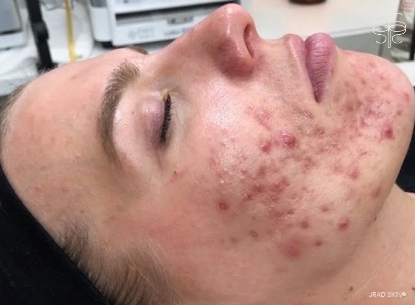 Before side-profile image of Amanda showing cystic acne, congestion, visible scarring and post-inflammatory pigmentation along the cheek and jawline.