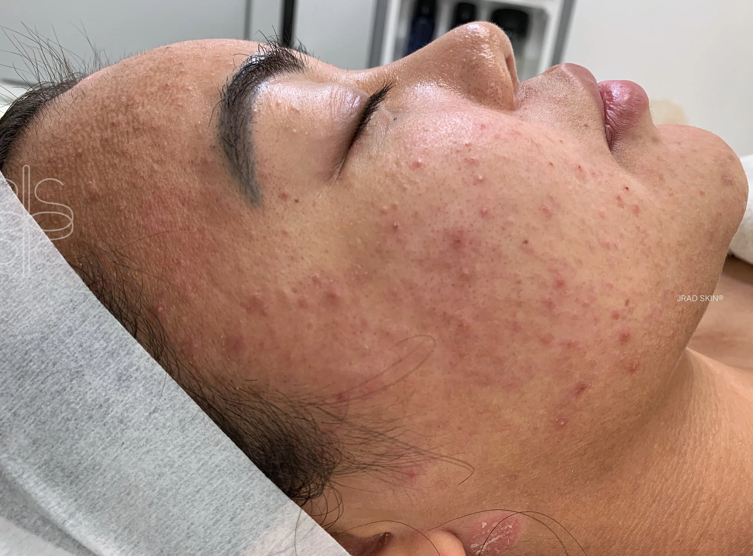 Before side-profile image showing pregnancy-related congestion, redness and post-inflammatory pigmentation along the cheek and jawline.