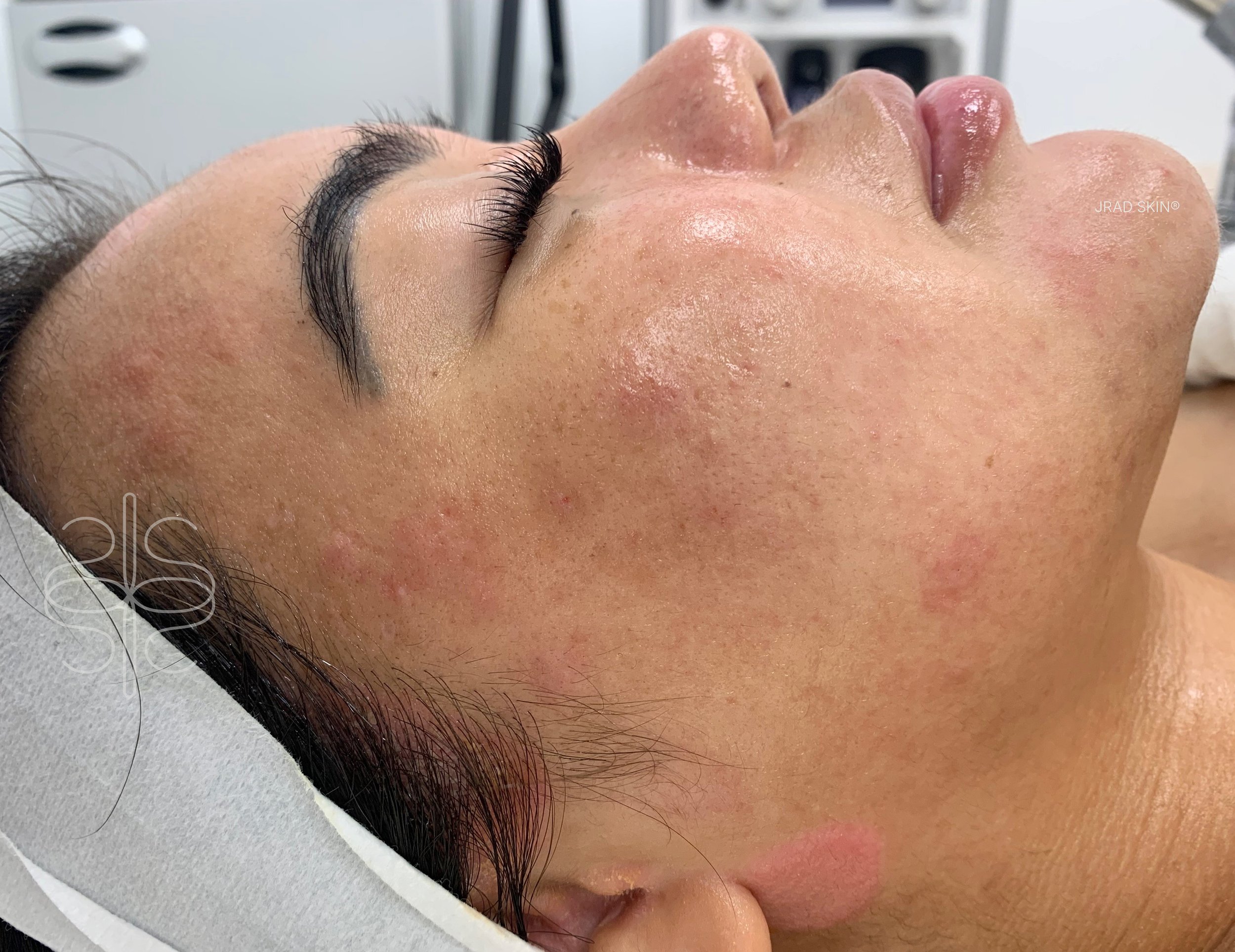 After side-profile image showing improved-looking clarity, calmer tone and fewer visible blemishes along the cheek and jawline.