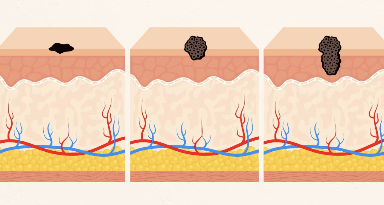 Melanoma Diagram showcasing the development of cancer cells migrating