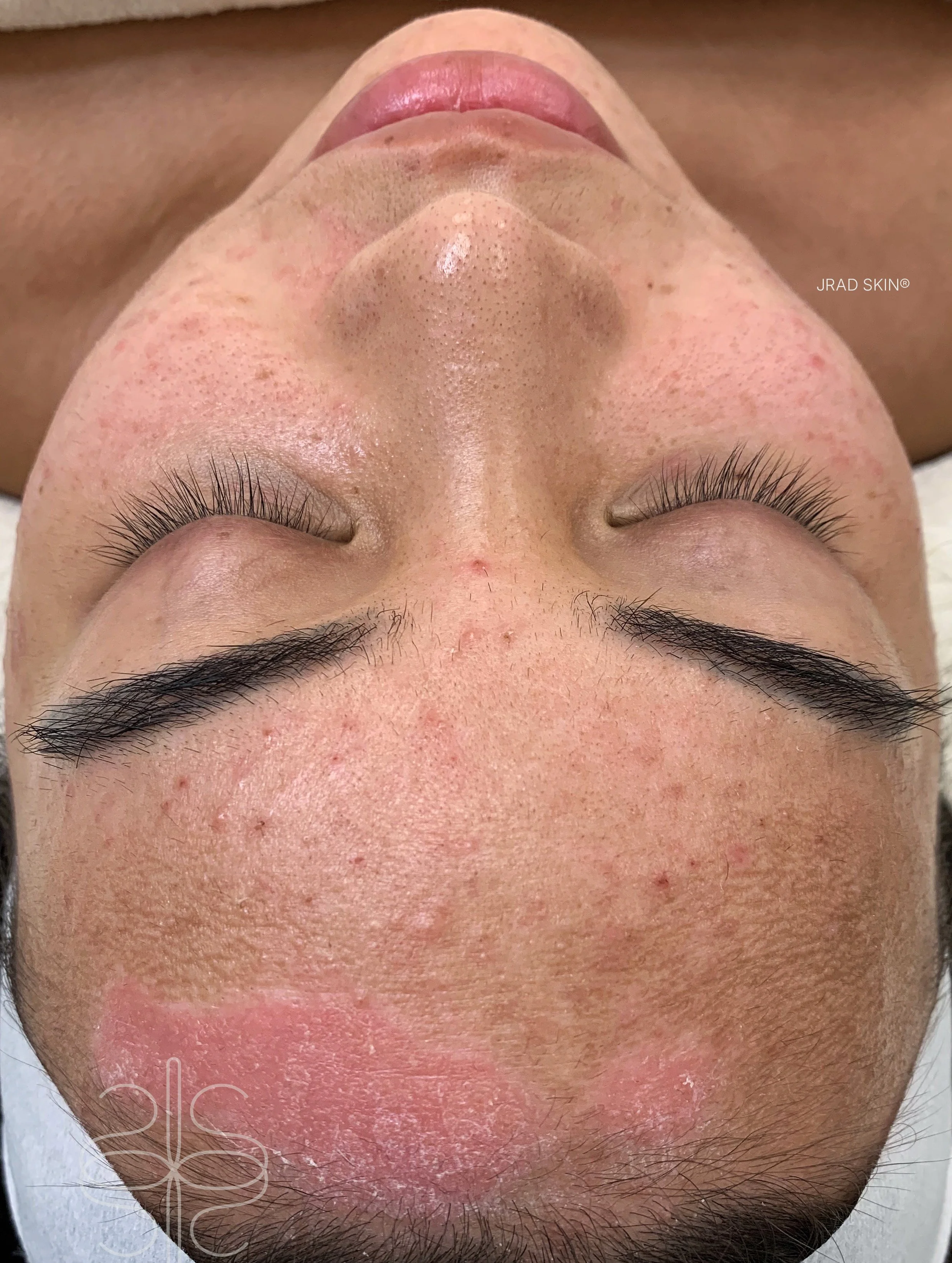 Before front-facing image showing psoriasis around the hairline, visible congestion and post-inflammatory pigmentation across the forehead and cheeks.