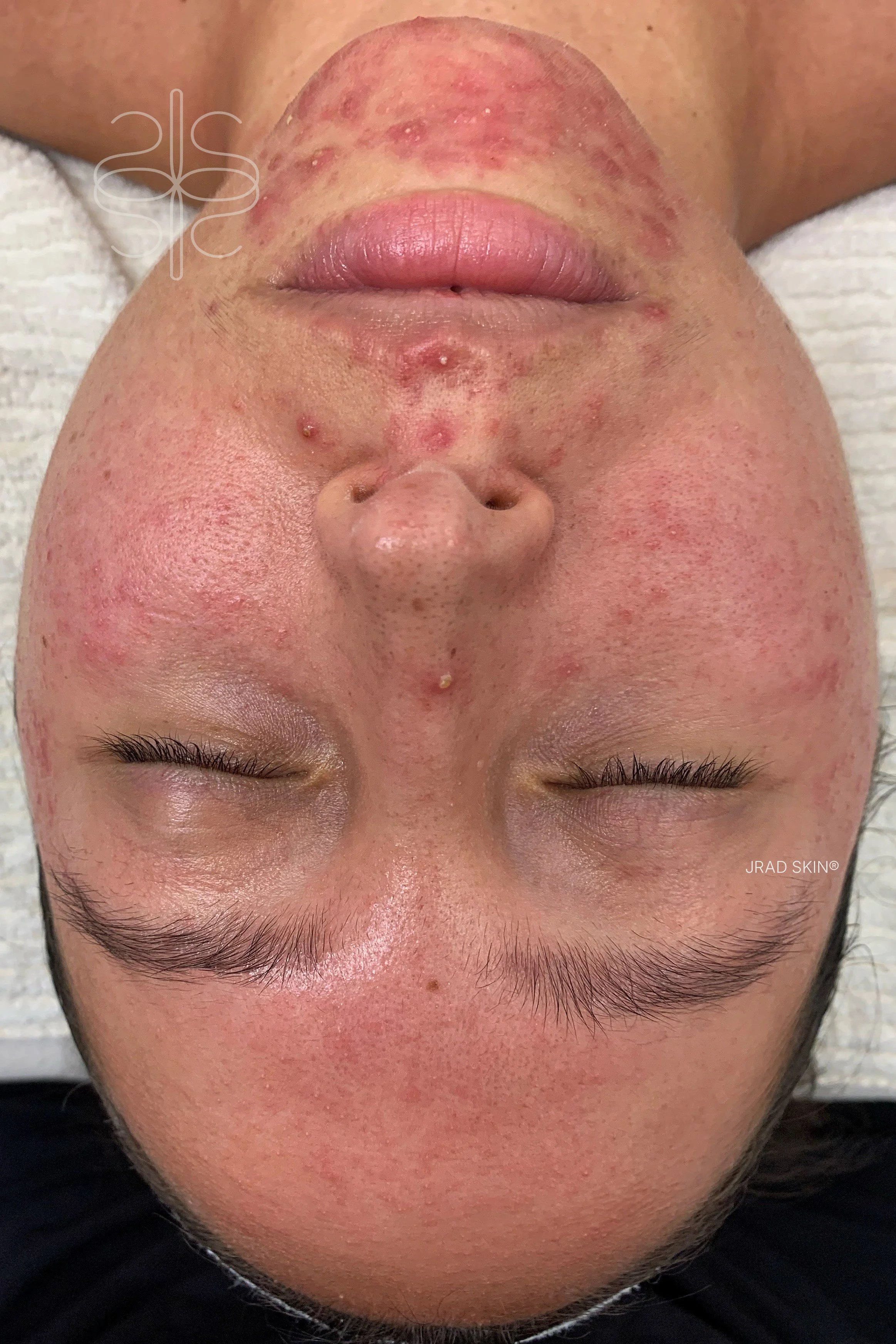 Before front-facing image showing widespread redness, inflamed blemishes and papulopustular rosacea across the cheeks, chin and forehead.