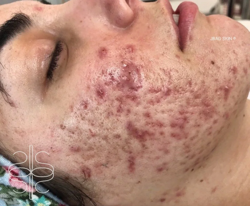 Before side-profile image showing active cystic acne, inflammation, texture irregularities and post-acne marking along the cheek and jawline
