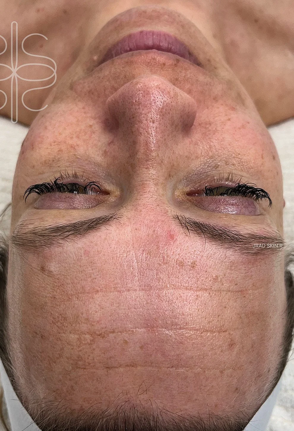 Before front-facing image showing sun damage, fine lines, redness and pigmentation across the forehead, cheeks and nose