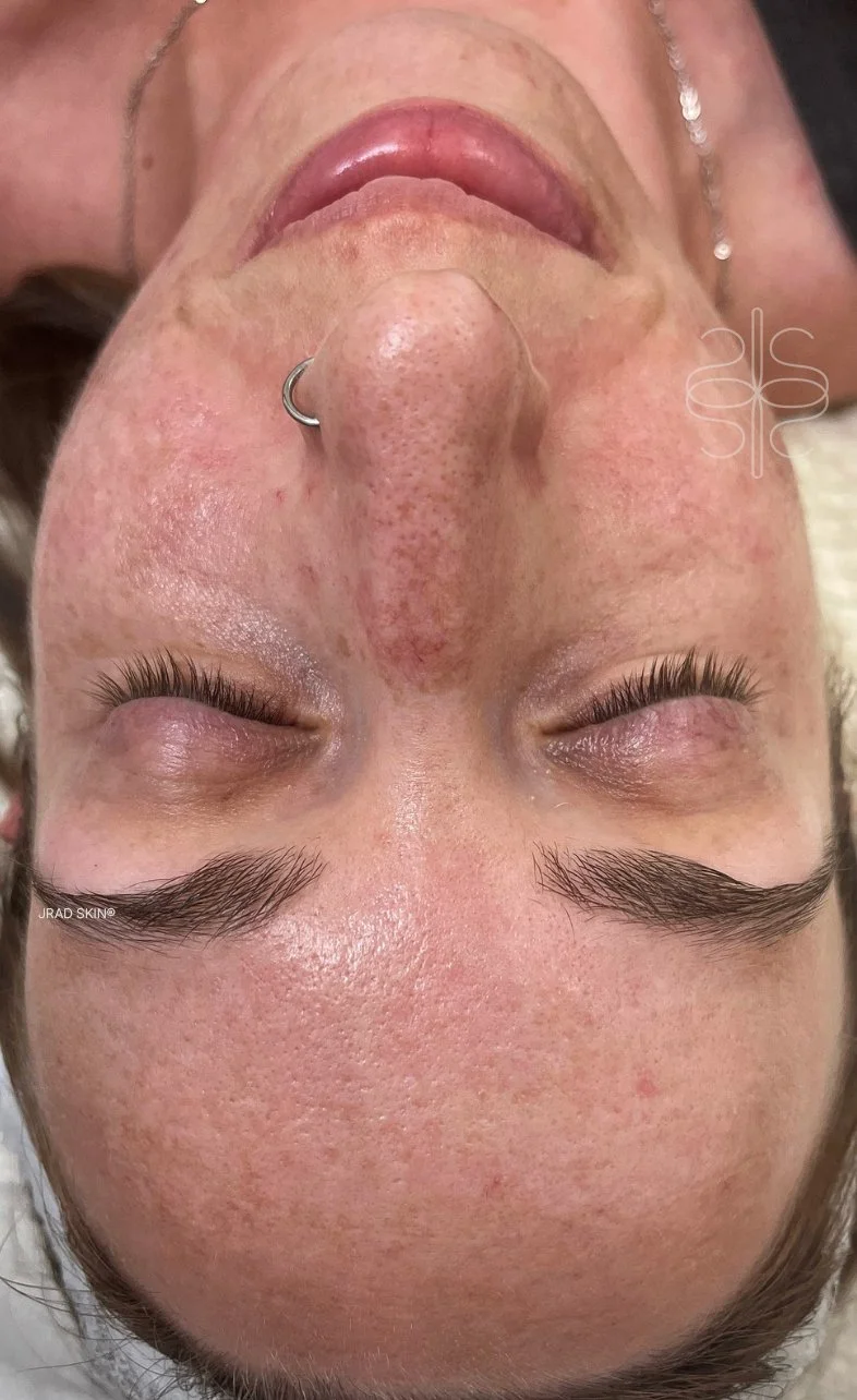 Before front-facing image of Caitlin showing visible redness, pigmentation, uneven texture and hormonal breakouts across the cheeks and forehead.