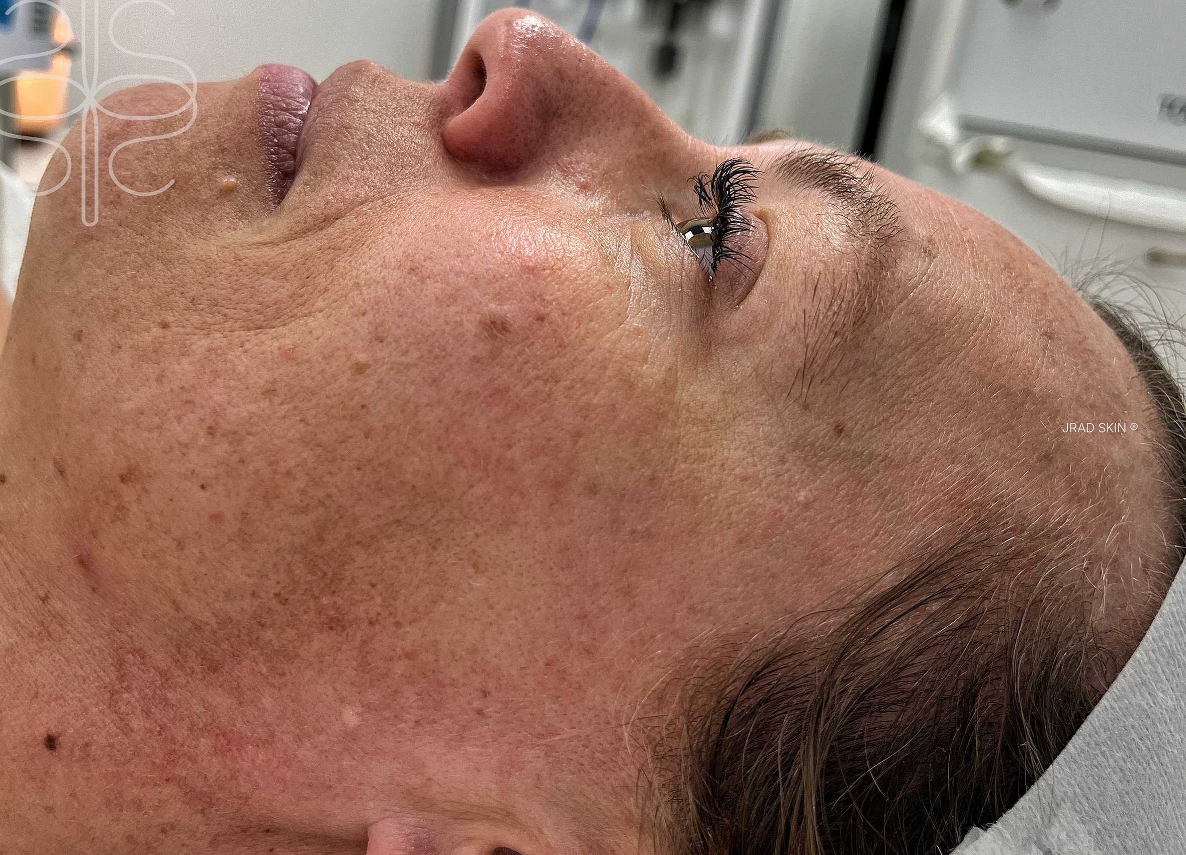 Before side-profile image showing pigmentation, fine lines and uneven texture along the cheek and temple area