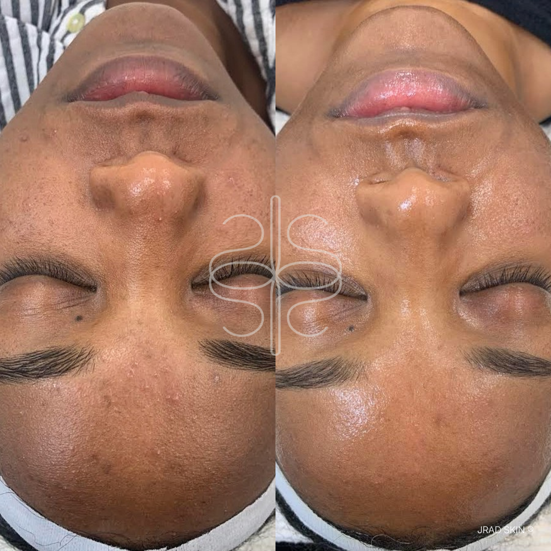 Before and after skin transformation showing improved-looking discolouration, texture and congestion across the lower face