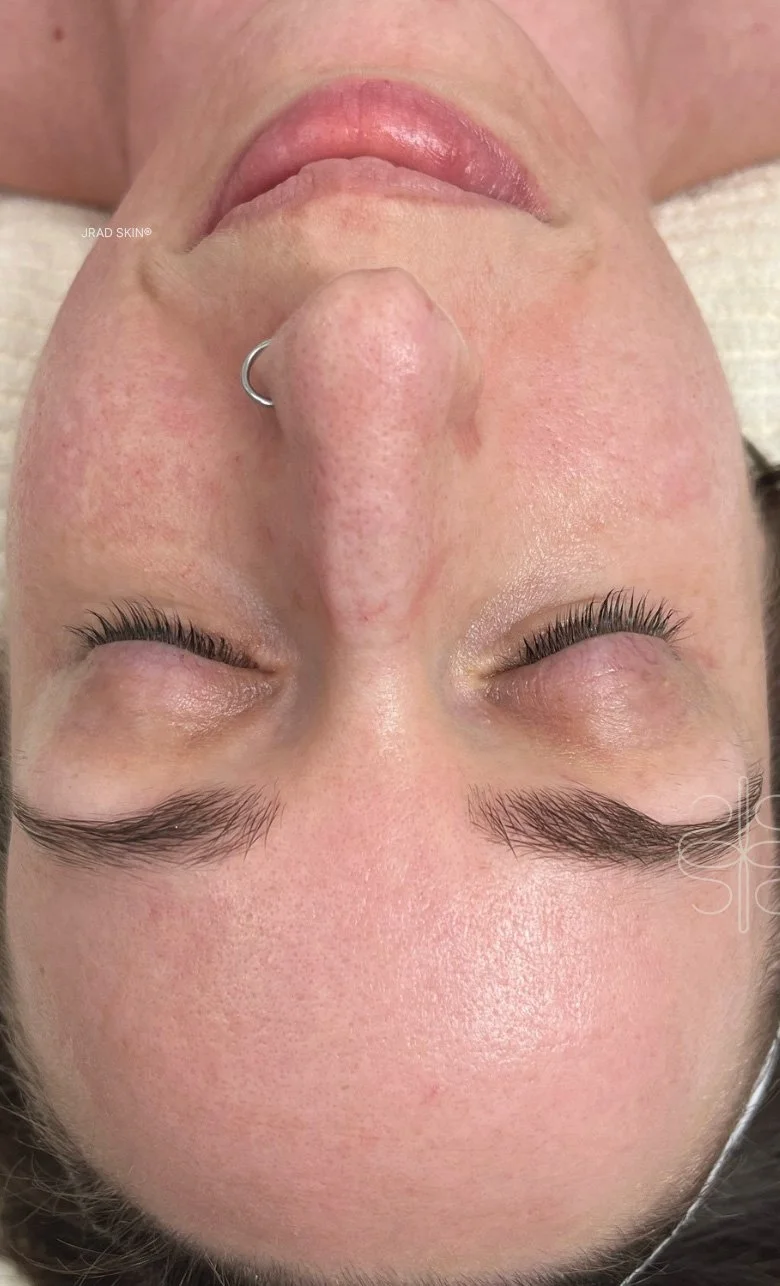 After front-facing image of Caitlin showing calmer-looking skin, softened pigmentation and a more even-looking tone across the cheeks and forehead.