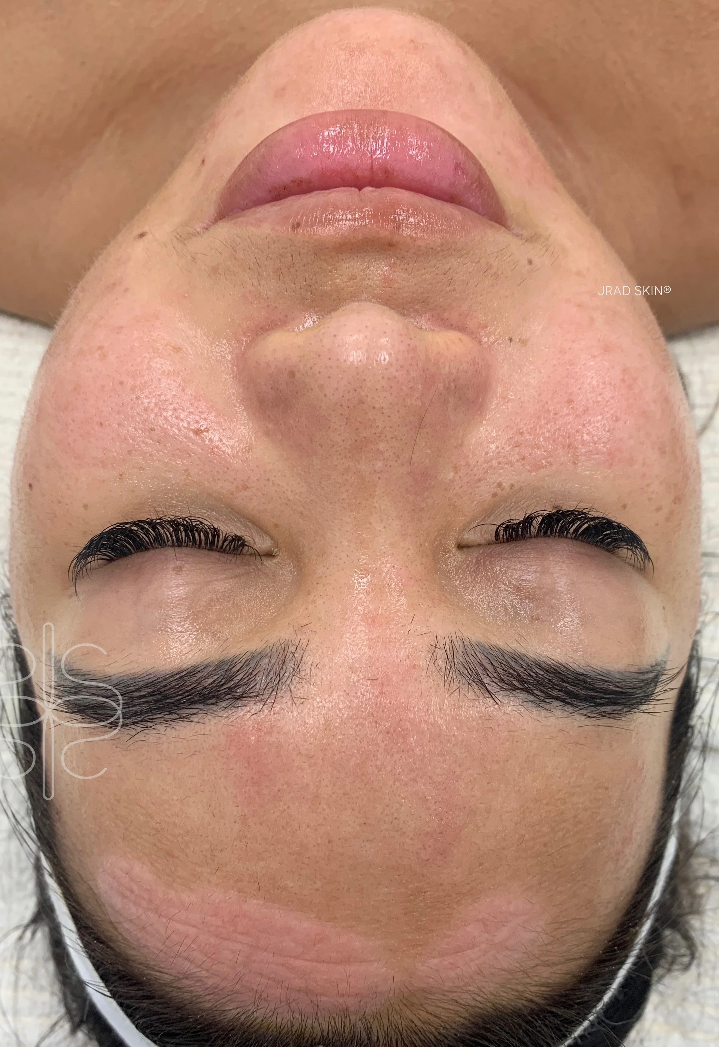 After front-facing image showing a calmer-looking complexion with reduced visible congestion and softer pigmentation across the forehead and cheeks.