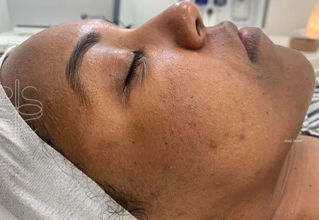 Before side-profile image of a Black woman showing visible texture and pigmentation on the cheek prior to JRAD SKIN treatment