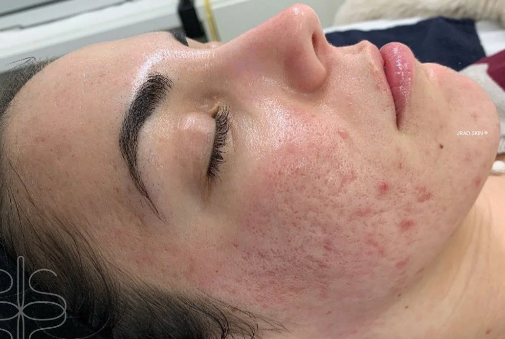After image showing calmer-looking skin with visible improvement in acne, inflammation, scarring and post-inflammatory pigmentation following JRAD SKIN treatment