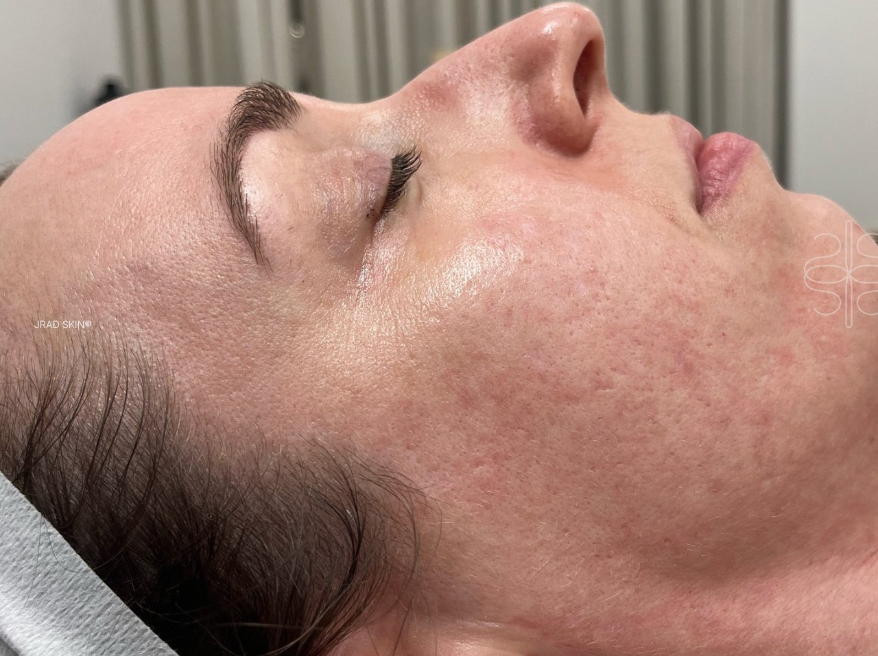 After side-profile image showing smoother-looking cheek texture, reduced visible redness and softened acne marks following JRAD SKIN treatment.