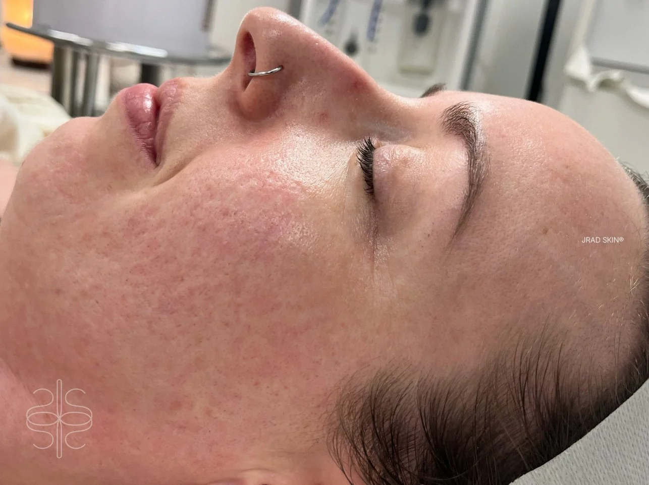 After side-profile image showing improved-looking skin clarity, calmer tone and softer visible pigmentation across the cheek and jawline.